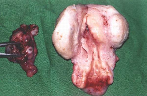 Adenomyosis Uterus 