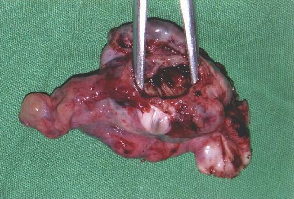 chocolate cyst