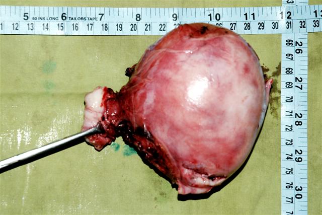 430 grams fibroid uterus reomved intact with out need of mor