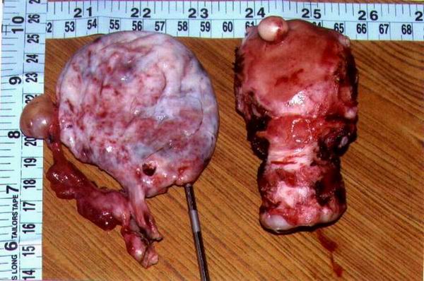 Uterus And A Right Ovarian Cyst