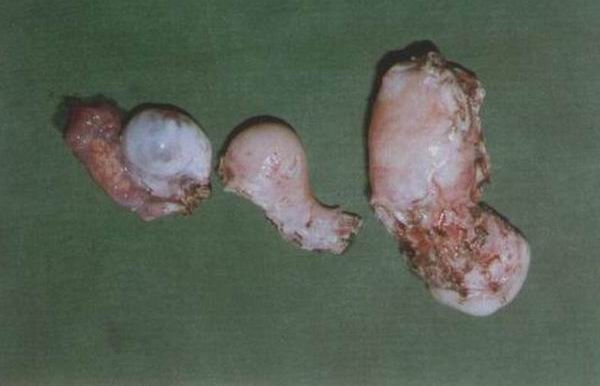 Both Horns Of Uterus And Right Ovary With Tube