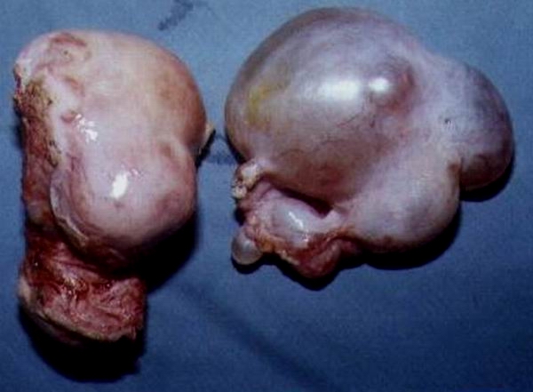 Fibroid Uterus And Adnexal Mass