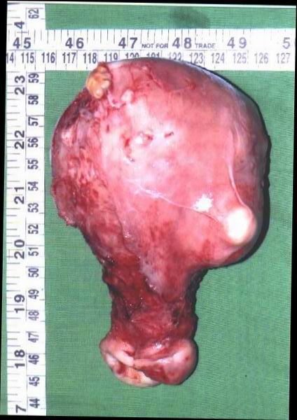 Fibroid Uterus