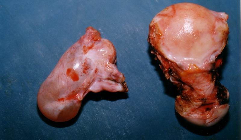 uterushydrosalpinx
